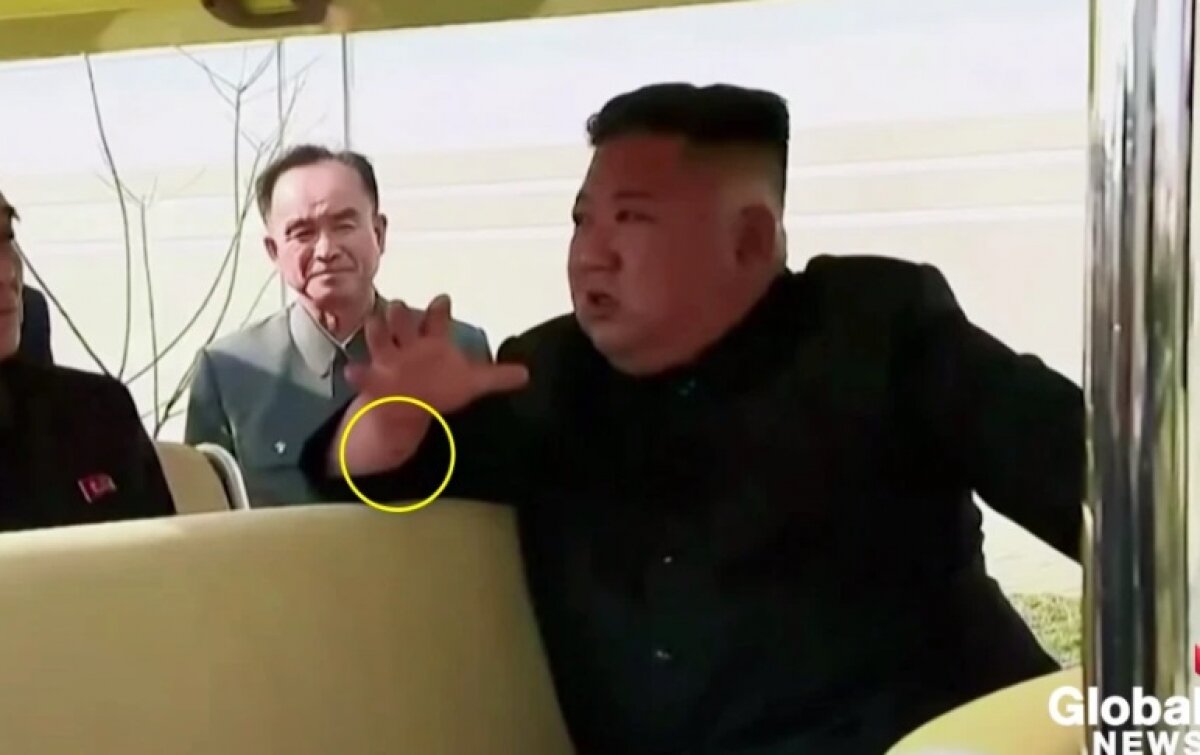 Ким Чен Ын засветил таинственный след на запястье 