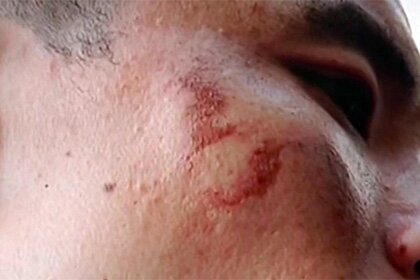 Взорвался брендовый iPhone 7, повредив лицо хозяина