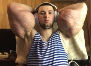 кирилл терешин, новости, россия, общество, руки-базуки, здоровье, медицина, новости дня, олеся малибу, стинол, операция