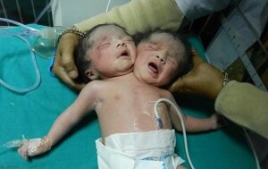 Бангладещ, общество, сиамские близнецы